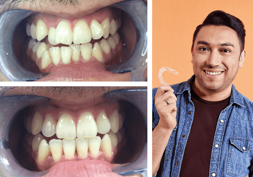Mordida cruzada antes y despues