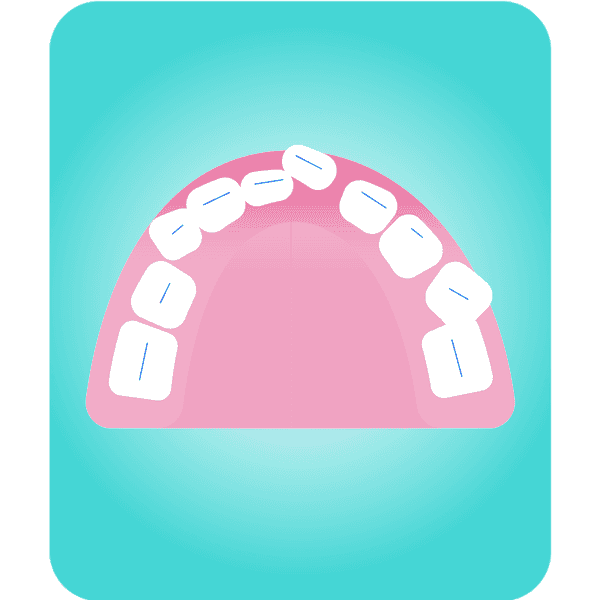 Ilustración de dientes no alineados
