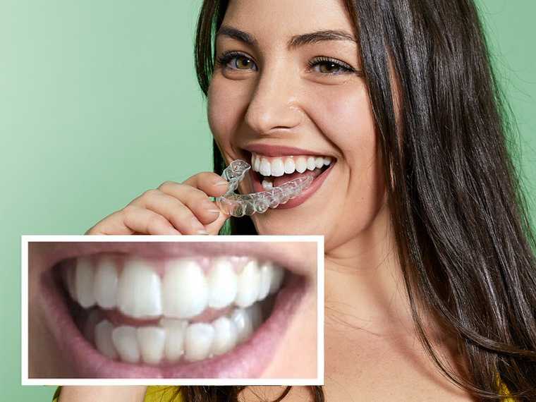 Chica con apiñamiento dental