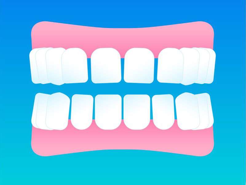 Ilustración de un diastema dental