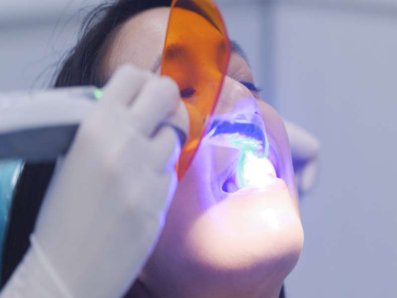 Blanqueamiento dental led
