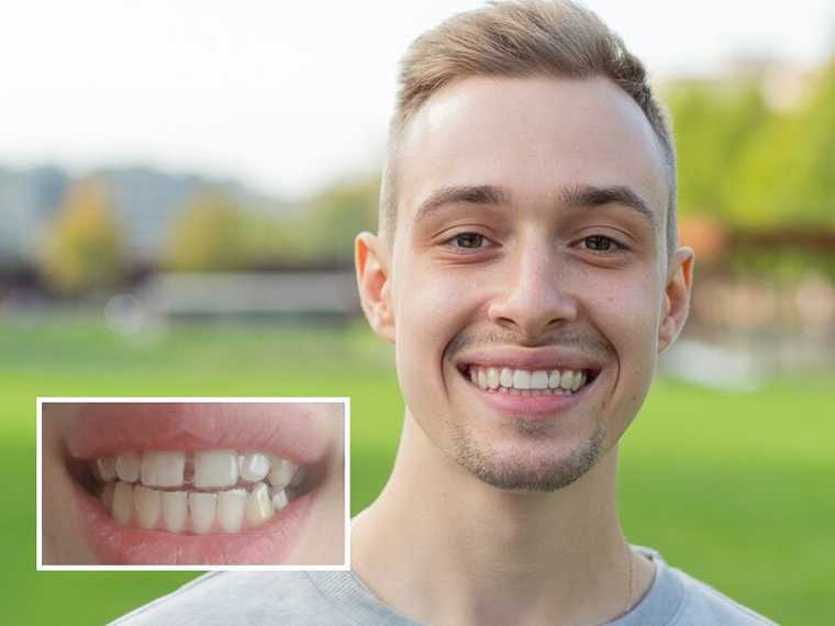 Antes y Despues de un chico con diastema