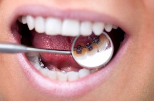 Foto de boca con ortodoncia lingual